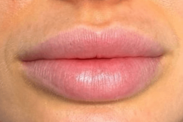 Lips Before Permanent makeup (2)
